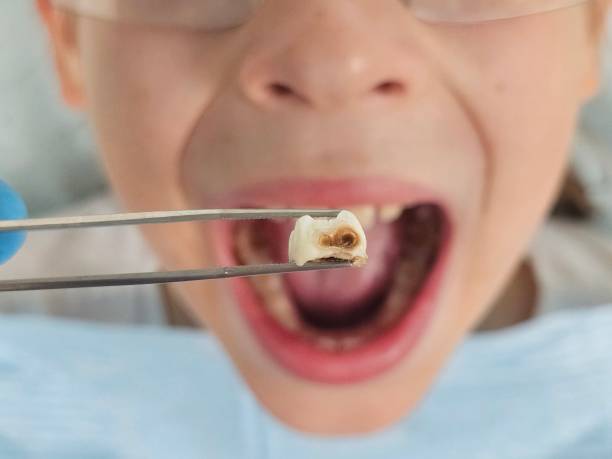 Best Emergency Wisdom Teeth Removal in Shelbyville, TN